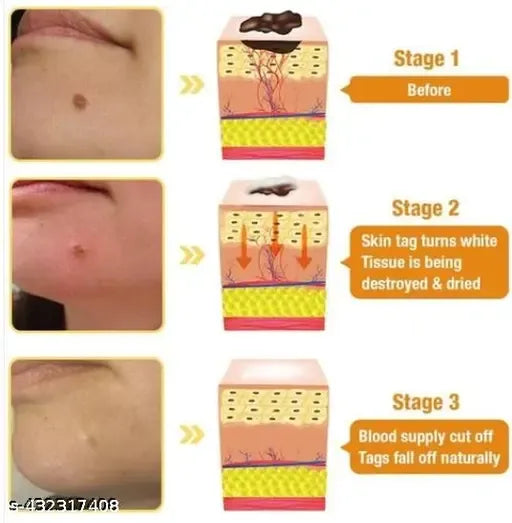 Derma Smooth Skin Tag Removal Patch - 72 Patches