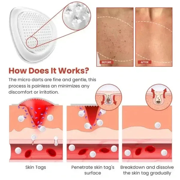 Derma Smooth Skin Tag Removal Patch - 72 Patches