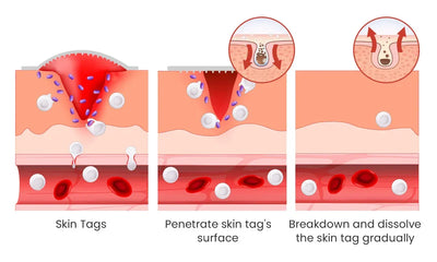 Derma Smooth Skin Tag Removal Patch - 72 Patches
