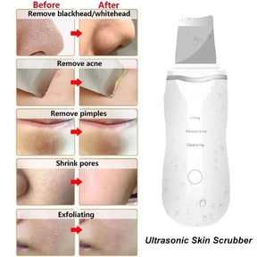 Ultrasonic Facial Skin Scrubber – Deep Cleanse & Glowing Skin in Minutes!